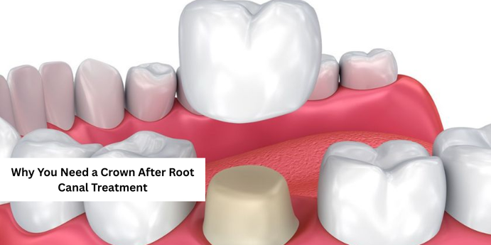 Why You Need a Crown After Root Canal Treatment