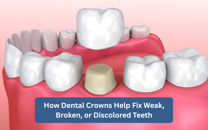 How Dental Crowns Fix Weak, Broken & Discolored Teeth