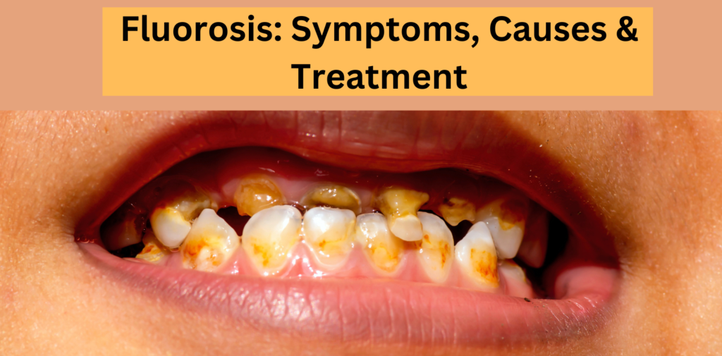 Fluorosis