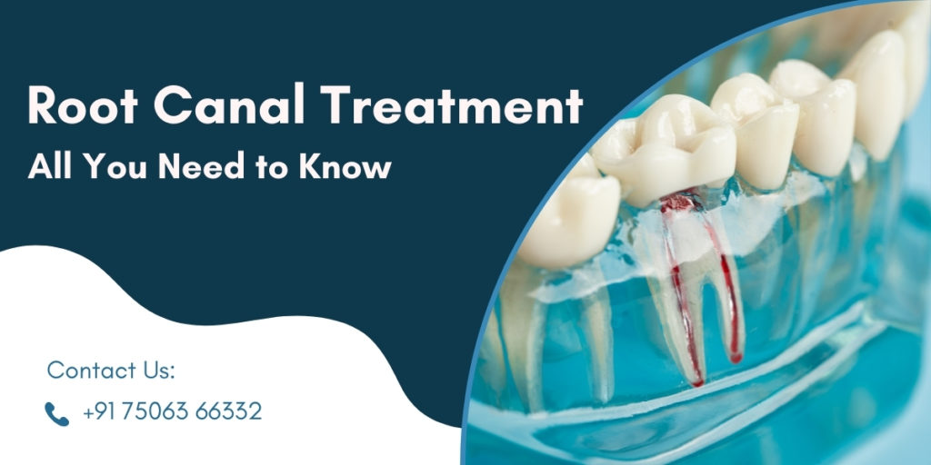 Root canal treatment: All you need to know