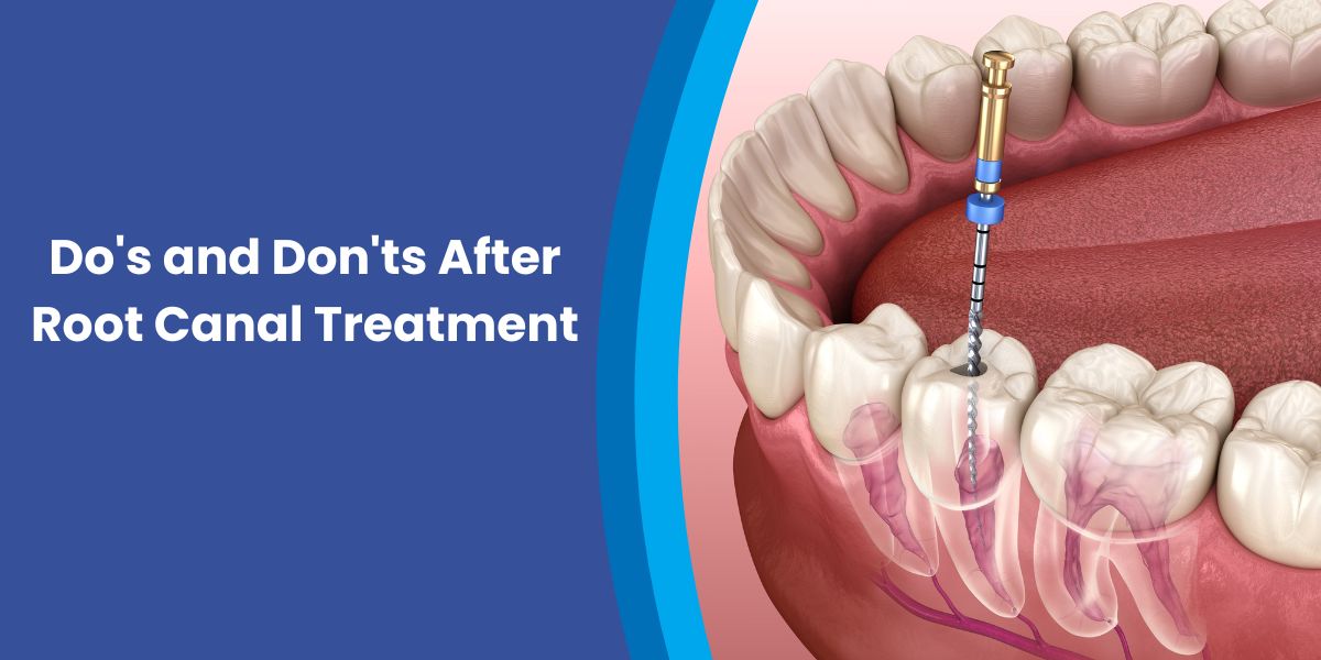 Do's and Don'ts After Root Canal Treatment