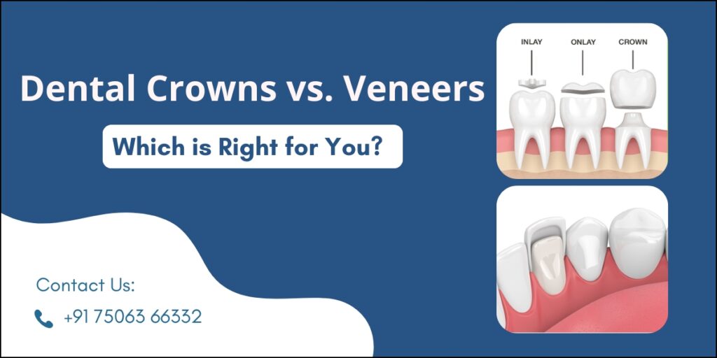 Dental Crowns vs. Veneers