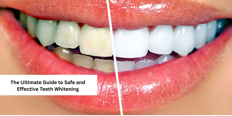 The Ultimate Guide to Safe and Effective Teeth Whitening